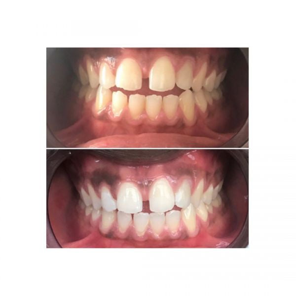 Duo de blanchiment des dents au charbon actif